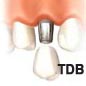 immediate implant ��� �ۿ� ���ö�Ʈ