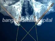 Implant NobelGuide Zygoma �뺧���̵� ���ư��� ���ö�Ʈ