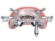 Implant NobelGuide Zygoma �뺧���̵� ���ư��� ���ö�Ʈ