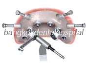 Implant NobelGuide Zygoma �뺧���̵� ���ư��� ���ö�Ʈ
