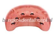 Implant NobelGuide Zygoma �뺧���̵� ���ư��� ���ö�Ʈ