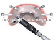 Implant NobelGuide Zygoma �뺧���̵� ���ư��� ���ö�Ʈ