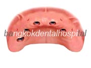 Implant NobelGuide Zygoma �뺧���̵� ���ư��� ���ö�Ʈ