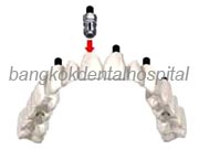 Implant NobelGuide Zygoma �뺧���̵� ���ư��� ���ö�Ʈ