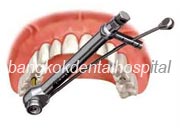 Implant NobelGuide Zygoma �뺧���̵� ���ư��� ���ö�Ʈ