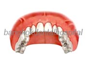 Implant NobelGuide Zygoma �뺧���̵� ���ư��� ���ö�Ʈ